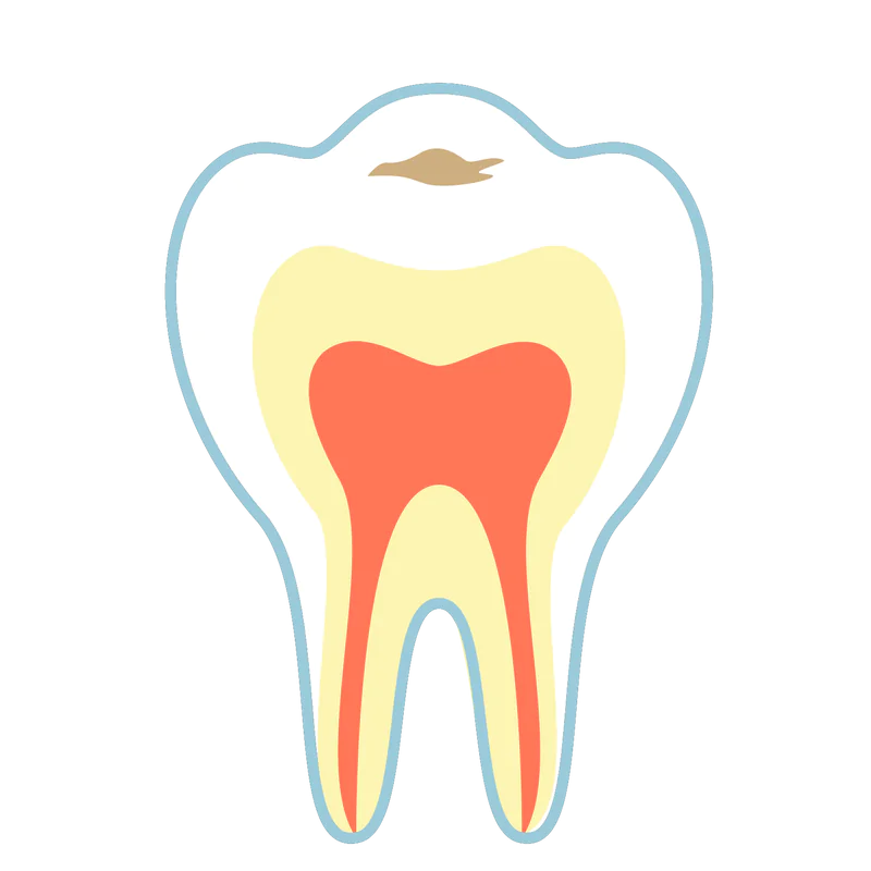 エナメル質の虫歯