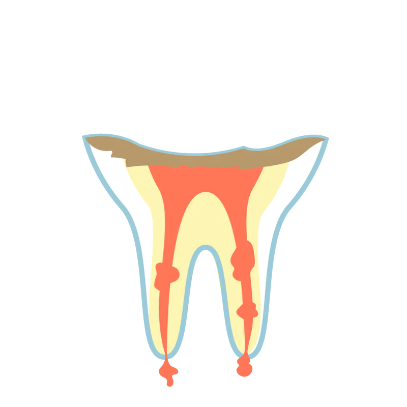 歯根にまで達した虫歯