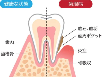 歯周病の原因は歯垢？