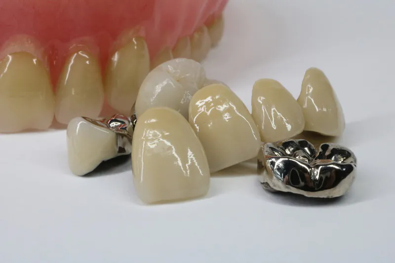 銀歯とセラミックはどっちを選ぶべき？